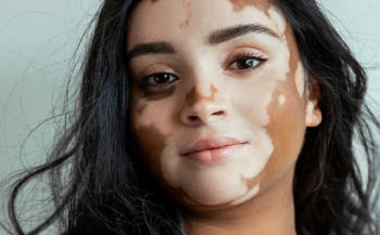 5 Penyakit Kulit yang Diidap Selamanya, Salah Satunya Vitiligo!