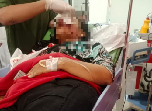 Hendak Jemput Anak, Pemotor Emak-Emak di Bogor Tertimpa Dahan Pohon Luka di Wajah